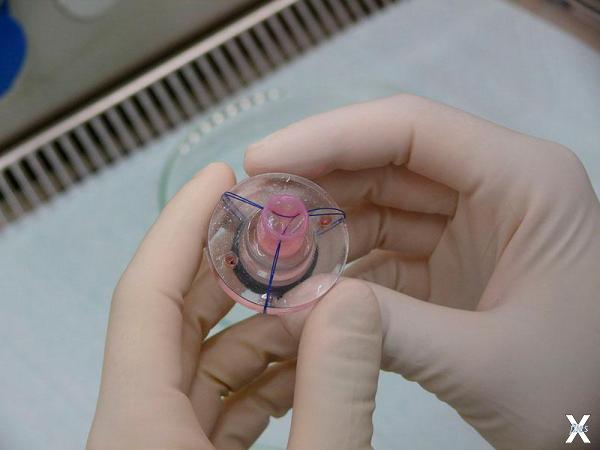 Так выглядит искусственный клапан сердца