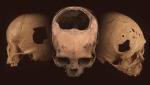 Инки - специалисты по трепанации черепа