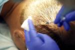 Современные методики трансплантация волос