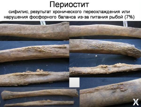 Патологии костей ног гребцов