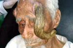 140-летний «человек-козел» умер после ампутации рогов