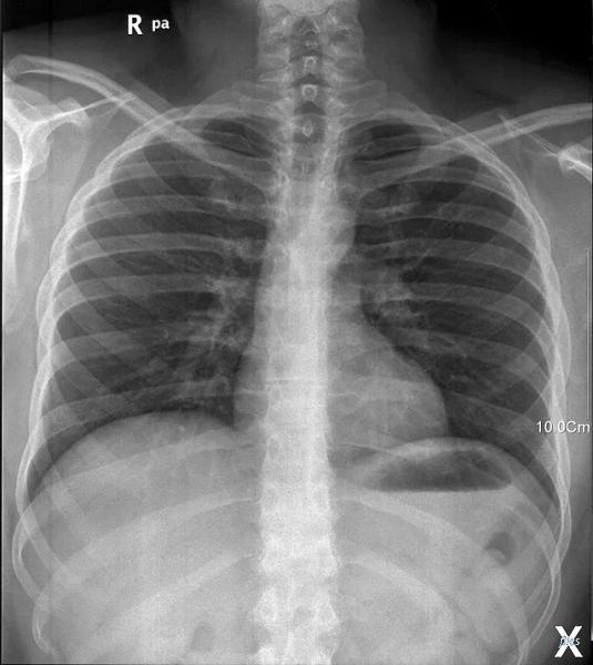 Рентгенограмма грудной клетки человека