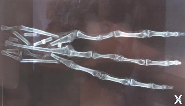 Рентгеновский снимок кисти