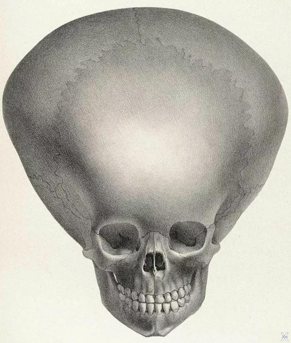 Череп малыша. Гидроцефалия форма черепа. Череп человека с гидроцефалией. Гидроцефалия головного мозга череп.