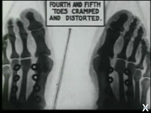 Рентгеновский снимок ступней ног в обуви