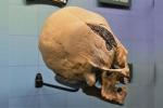 Металлическая плита в черепе: древний имплант или современная подделка?
