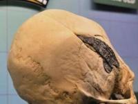 Металлическая плита в черепе: древний имплант или современная подделка?